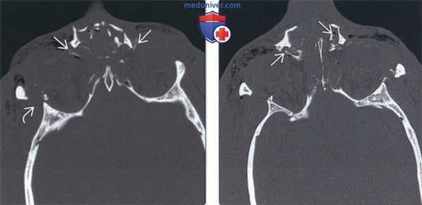 Лучевая диагностика перелома назоэтмоидального комплекса