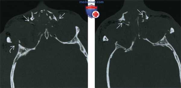 Назо-орбито-этмоидальный перелом - лучевая диагностика
