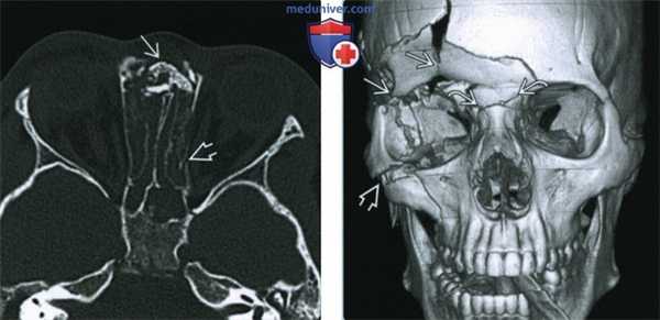 Назо-орбито-этмоидальный перелом - лучевая диагностика