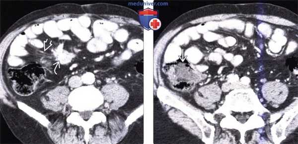 Рентгенограмма, КТ, МРТ при карциноиде (карциноидной опухоли) желудочно-кишечного тракта