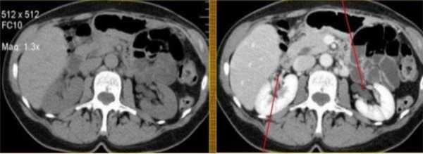  КТ почек без контраста (слева) и с контрастом (справа): стрелками указаны сосуды в воротах почек
