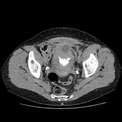 КТ мочевого пузыря