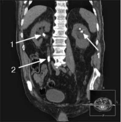 Конкременты в чашечно-лоханочной системе и мочеточнике, выявленные на КТ (указаны стрелками)