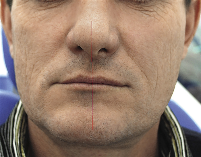 Рис.8. Симметрия лица, состояние физиологического покоя, 9 лет после операции.