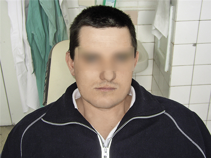 Рис. 1. Подбородок смещен в правую сторону, состояние физиологического покоя.