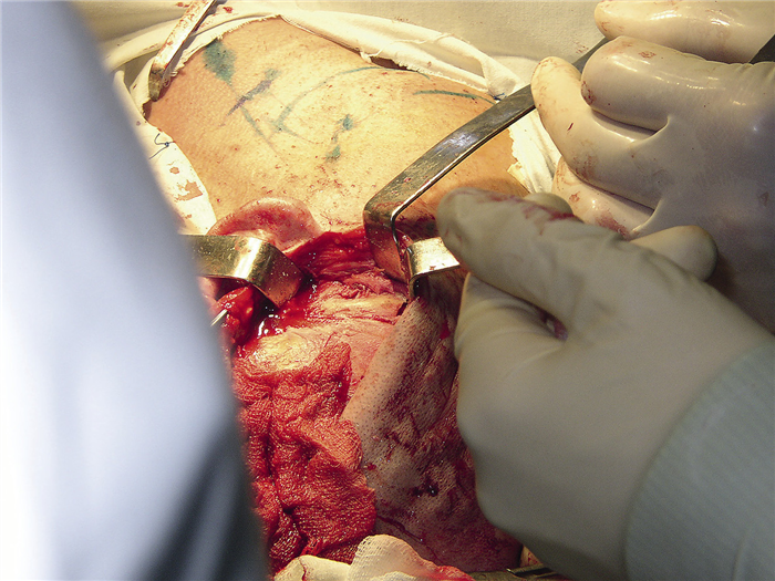 Рис. 4. Операционная рана, венечный доступ, остеотомия скуловой дуги: 1 — скуловая дуга, 2 — области остеотомий.