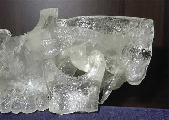 Рис. 3. Стереолитографическая модель черепа, новообразование левого мыщелкового отростка нижней челюсти.