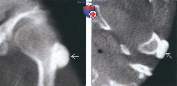 Лучевая диагностика остеомы височно-нижнечелюстного сустава (ВНЧС)