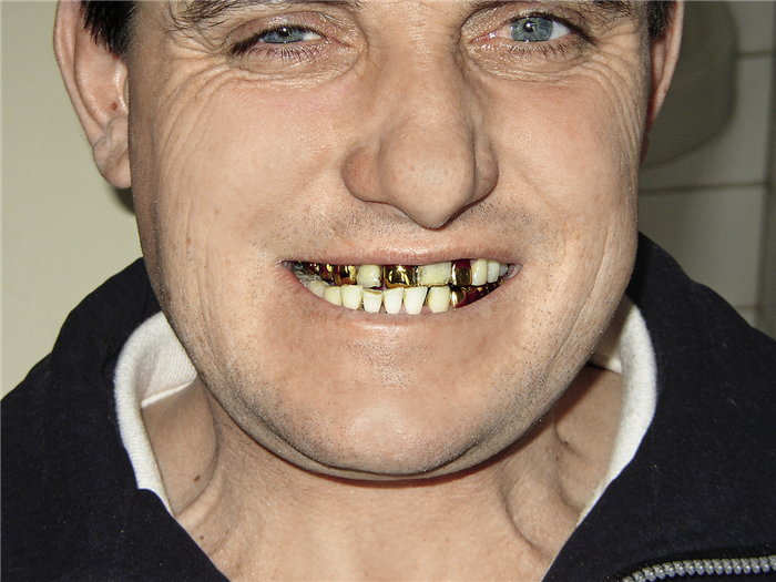 Рис. 2. В предкозелковой области четко пальпируется смещенная латерально головка левого ВНЧС.