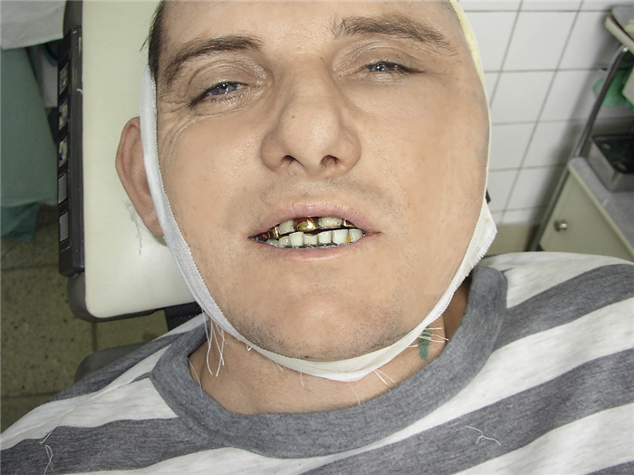 Рис. 7. Состояние физиологического покоя нижней челюсти на первый день после операции. Смыкание зубов в физиологическом прикусе с восстановлением средней линии.