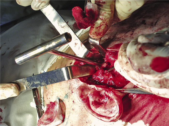 Рис. 5. Область подвисочной ямки, создан доступ к новообразованию.