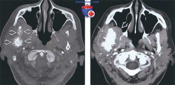 Лучевая диагностика остеосаркомы височно-нижнечелюстного сустава (ВНЧС)