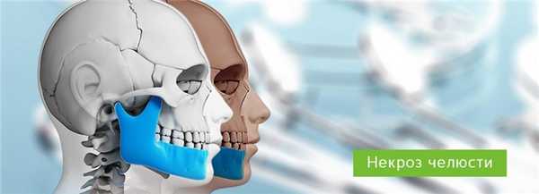 Некроз челюсти: причины и методы лечения