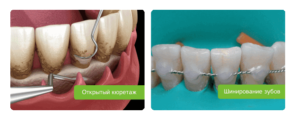 лечение остеонекроза челюсти