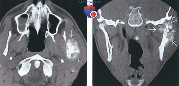 Лучевая диагностика остеосаркомы височно-нижнечелюстного сустава (ВНЧС)
