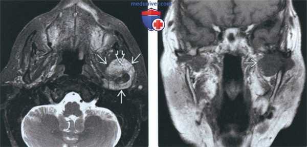 КТ, МРТ при хондросаркоме височно-нижнечелюстного сустава (ВНЧС)