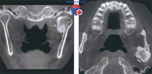 Лучевая диагностика остеомы височно-нижнечелюстного сустава (ВНЧС)