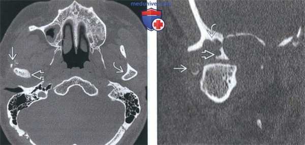КТ, МРТ при хондросаркоме височно-нижнечелюстного сустава (ВНЧС)