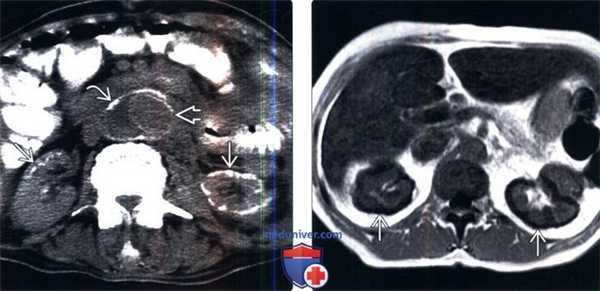 КТ, МРТ, УЗИ при кортикальном некрозе почки
