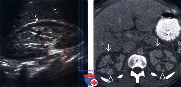 КТ, МРТ, УЗИ при кортикальном некрозе почки