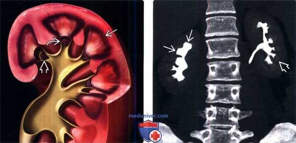 КТ при папиллярном некрозе почки