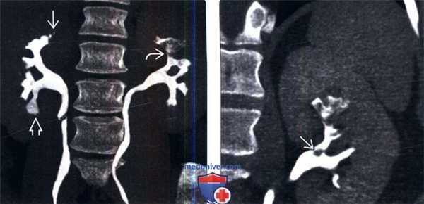 КТ при папиллярном некрозе почки