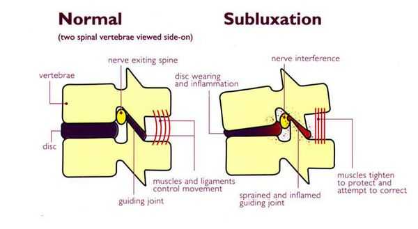 Здоровые позвонки и подвывих позвонка