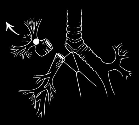 Схема верхней бронхопластической лобэктомии