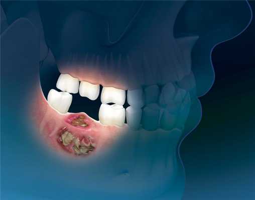 Плоскоклеточный рак нижней челюсти