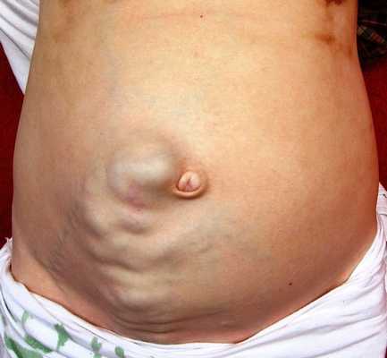 Расширение вен передней брюшной стенки при портальной гипертензии