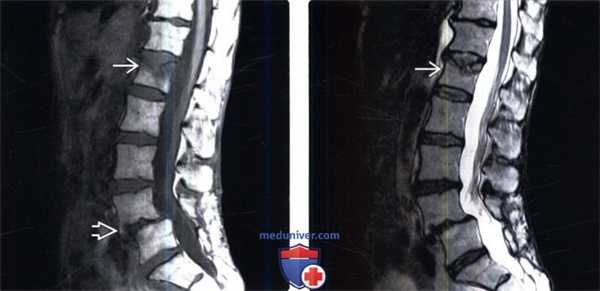 КТ при послеоперационной деформации позвоночника