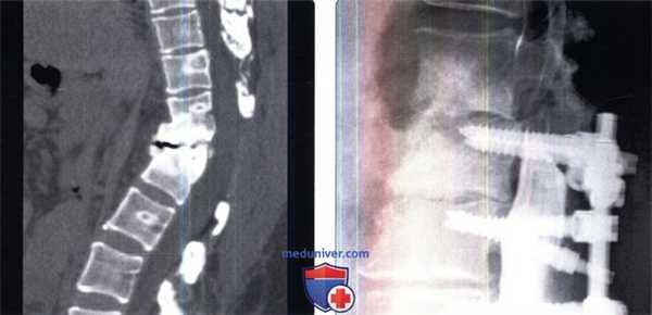 КТ при послеоперационной деформации позвоночника