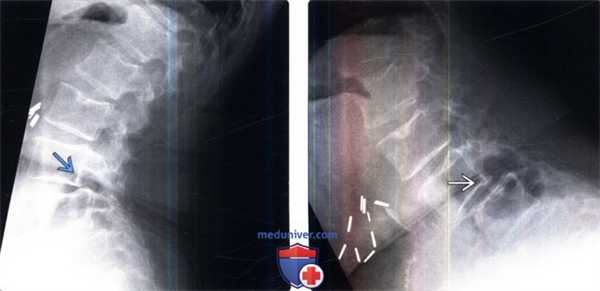 КТ при послеоперационной деформации позвоночника