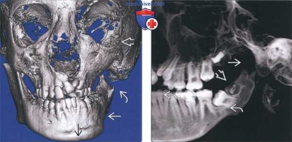Лучевая диагностика аплазии мыщелка височно-нижнечелюстного сустава (ВНЧС)