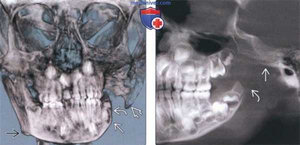 Лучевая диагностика аплазии мыщелка височно-нижнечелюстного сустава (ВНЧС)