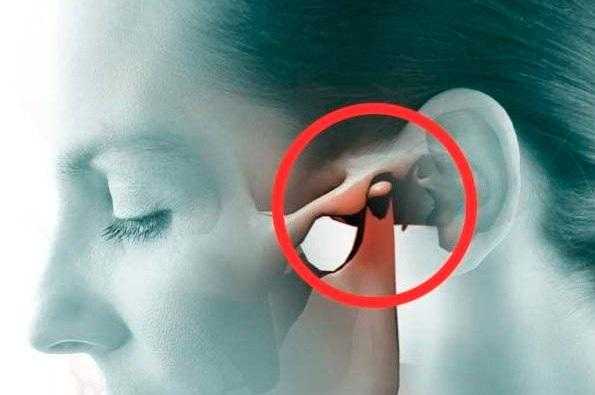 Реконструкция ВНЧС аллопластическим протезом (анализ 4 клинических случаев)