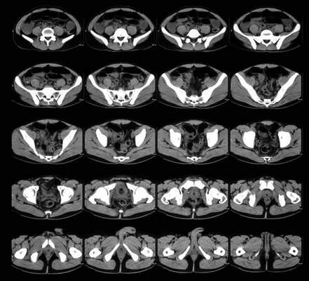 Органы малого таза (мужского) на томограммах