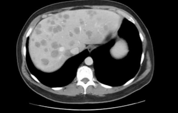Метастазы в печени на снимке МСКТ