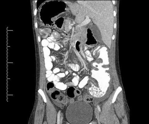 МСКТ брюшной полости (достроена фронтальная проекция)