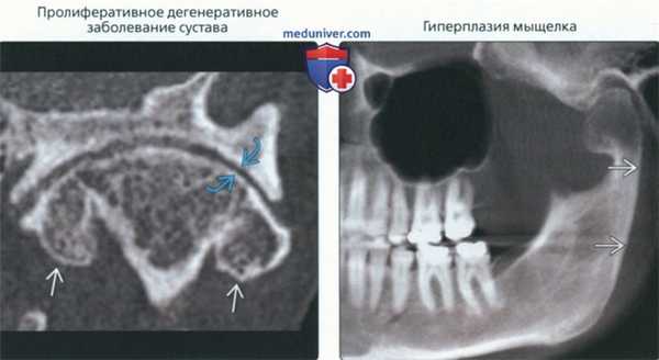 Рентгенограмма, КТ, МРТ при увеличении мыщелка височно-нижнечелюстного сустава (ВНЧС)