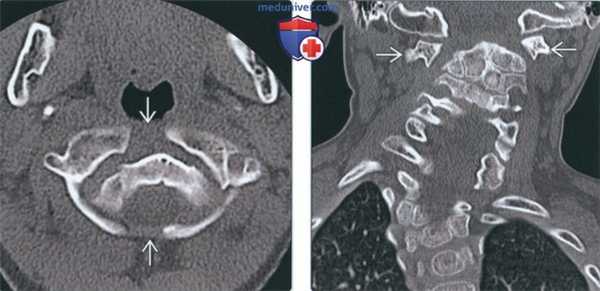Лучевая диагностика расщепления атланта (С1 позвонка)