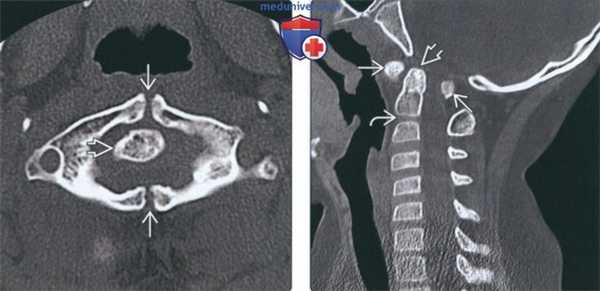 Лучевая диагностика расщепления атланта (С1 позвонка)