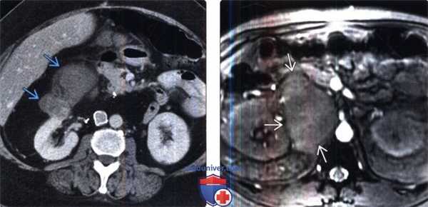 КТ при саркоме забрюшинного пространства
