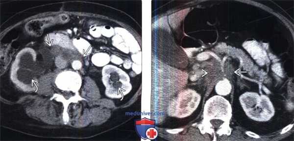 КТ, МРТ при забрюшинных метастазах