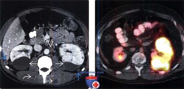КТ, МРТ при забрюшинных метастазах