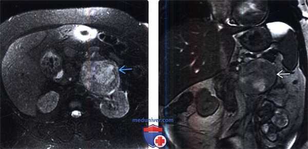 КТ при саркоме забрюшинного пространства