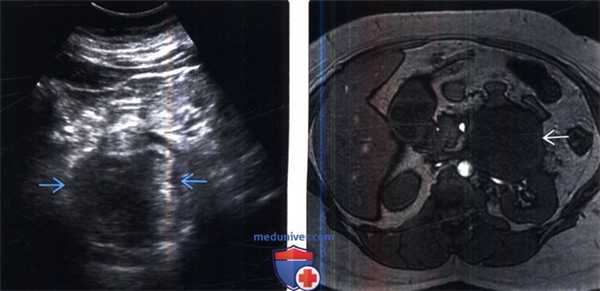 КТ при саркоме забрюшинного пространства