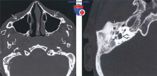 Лучевая диагностика синдрома Тричера Коллинза