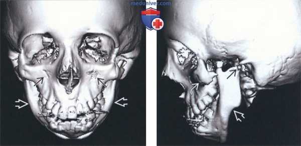 Лучевая диагностика синдрома Тричера Коллинза