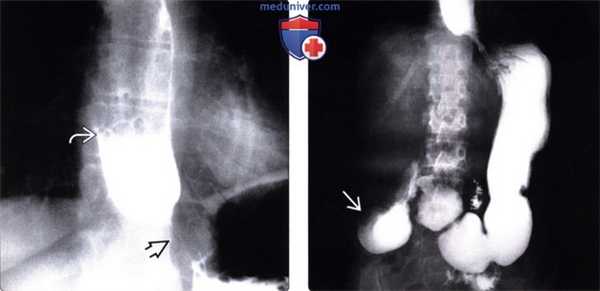 Рентгенограмма (эзофагография) при склеродермии пищевода